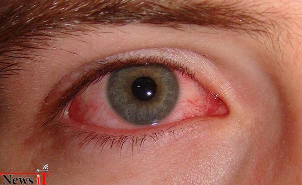 حل مشکل خشکی چشم با ایمپلنتی به شکل وایرلس